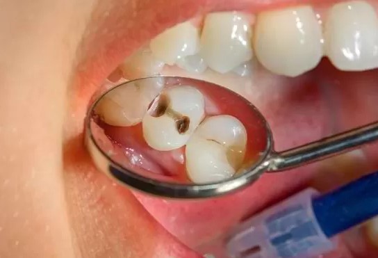 5 Cara Ampuh Mengatasi Karies Gigi